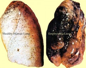 emphysema-lung